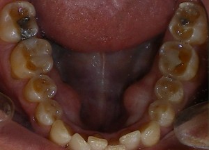 severe tooth damage due to acid refLux (GERD)