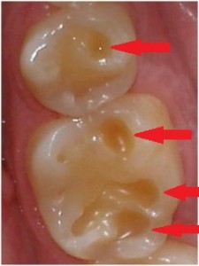 dental consequences of acid reflux (GERD) on teeth