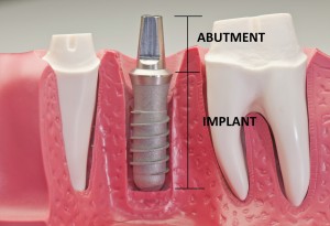 Titanium Dental Implant in Allen TX and Plano TX