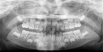 Baby teeth above adult teeth in x-ray