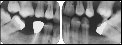 loss of space due to missing teeth from dental emergency extraction