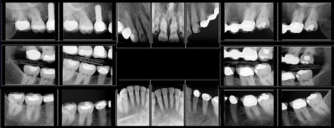 Digital X-Rays in Allen, TX Dental Center to Minimize Radiation Exposure