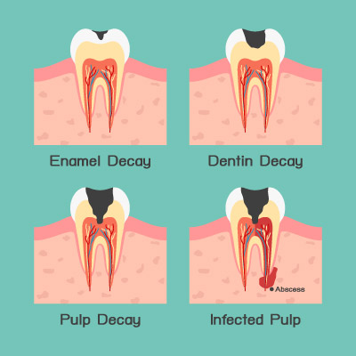 cavity formation leads to severe toothache and dental emergency
